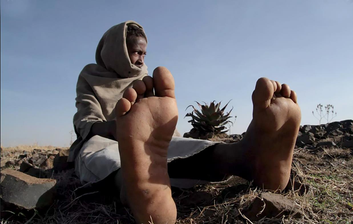 Preventing-Mycetoma-Sudan-2019